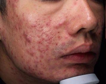 「掌健识」ALA-PDT治疗中重度*疮痤**