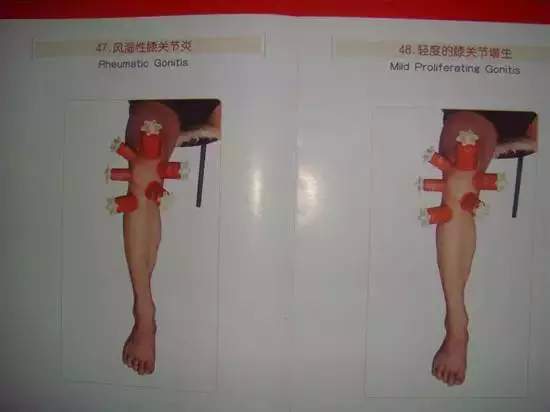 拔罐有哪些穴位图解,最全拔罐穴位疗法图解