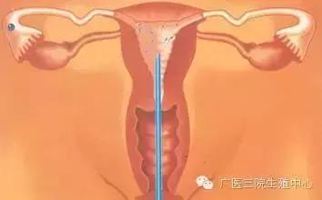 科普人工授精,科普一下人工授精