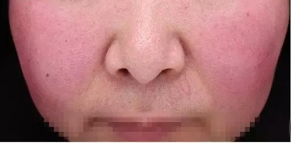 洗脸洗多了毛孔变大怎么办,洗脸洗成痘痘肌