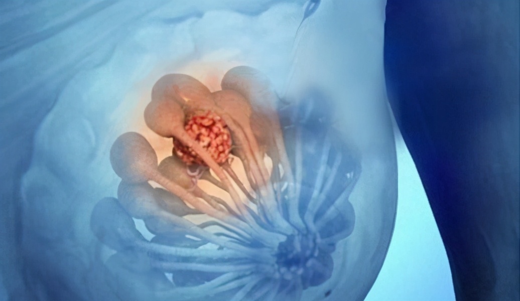 乳腺结节患者，结节小不能手术，选择中医调治2个月结节消失不见