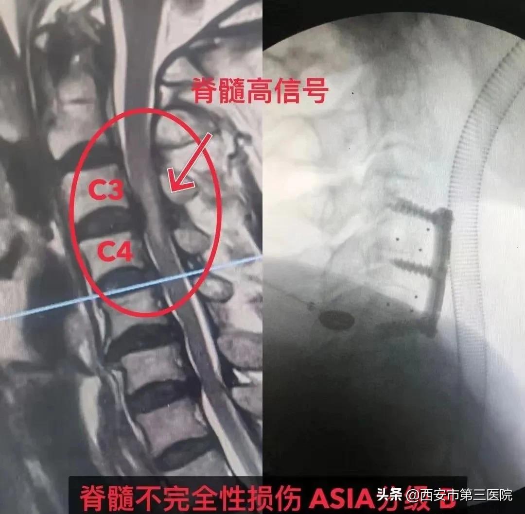 颈椎病减压手术安全么,手术脊髓减压
