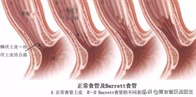 食管裂孔疝和贲门松弛哪个危害大,出现食管裂孔疝是怎么回事