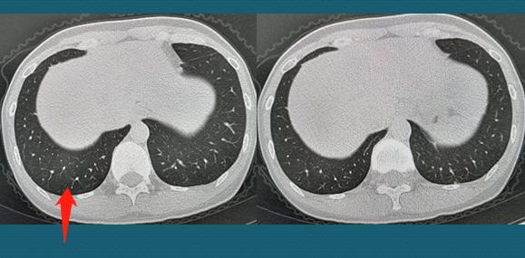 两名病情好转的心冠患者,轻度病毒性肺炎20天快好了