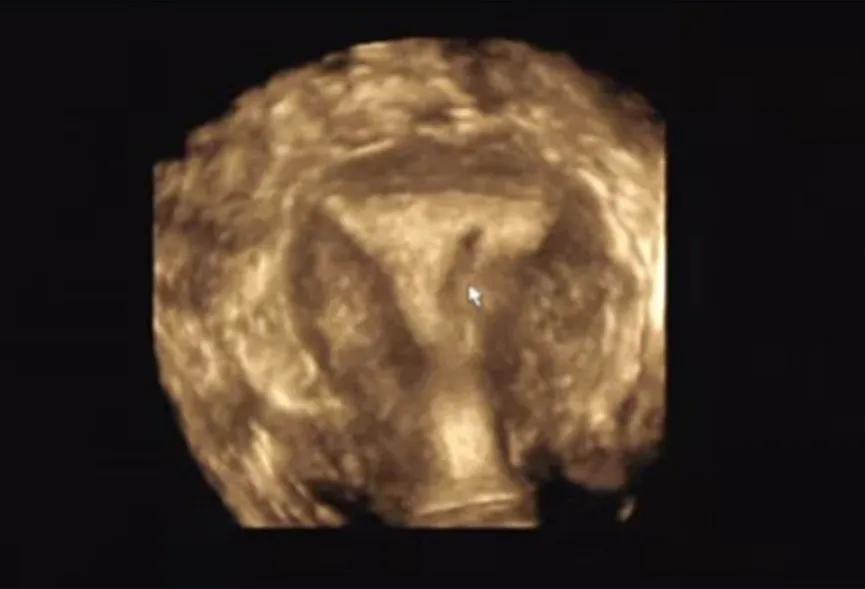 关爱女性｜呵护子宫，不可忽视“宫腔粘连”