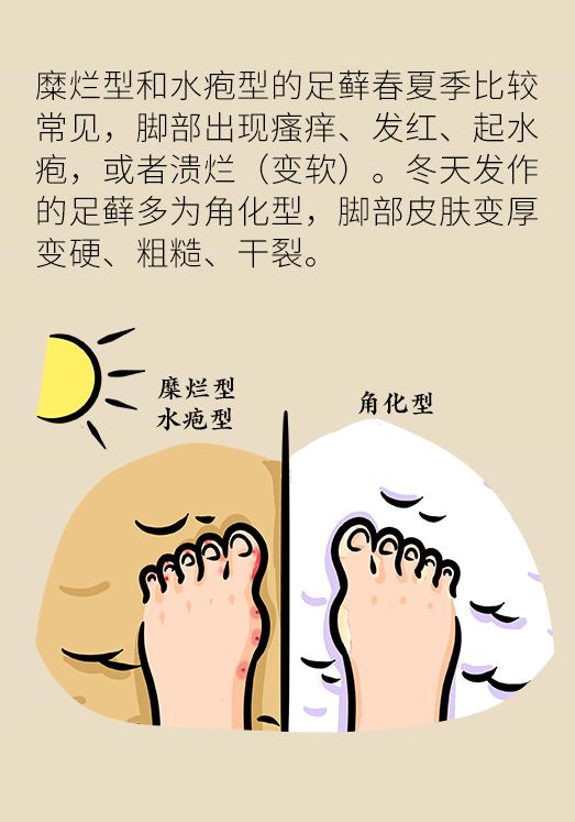 脚气脚痒烂脚丫怎么根治,脚气脚痒老方法