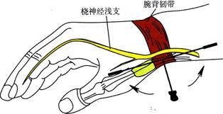 腱鞘炎手指解说图,腱鞘炎介绍