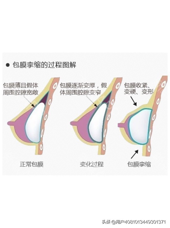 怎样预防隆胸包膜挛缩症状,假体隆胸后吃辣椒会包膜挛缩吗