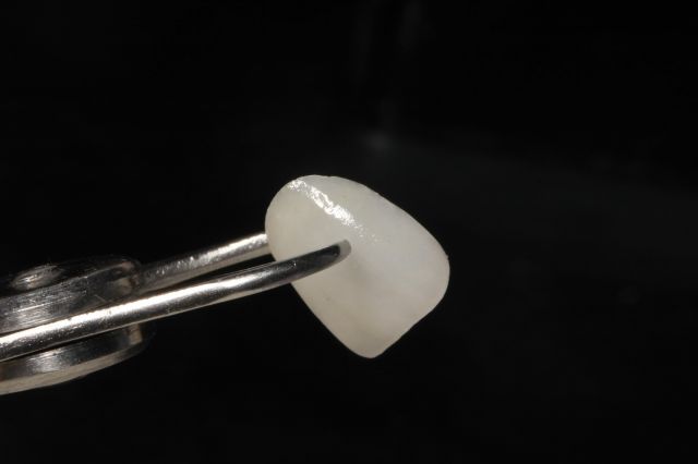 瓷贴面美牙优缺点,什么是全瓷贴面美牙