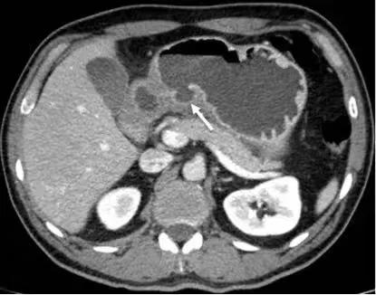 腹部ct能看出来胃的毛病吗,如果胃有问题腹部ct看得出来吗