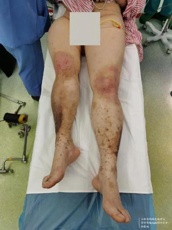 男子脚骨折去医院,男子脚伤手术后仍一瘸一拐