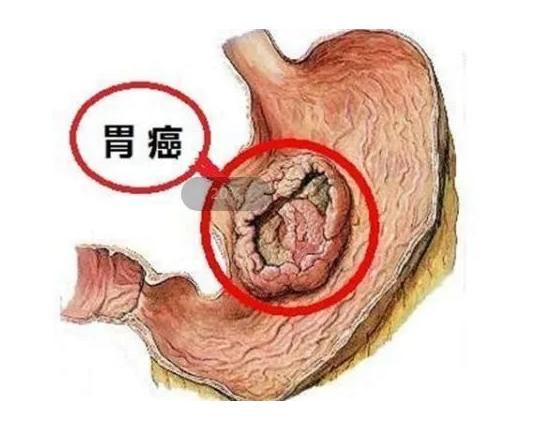 抗胃癌新药物,胃癌特效注射药有作用吗