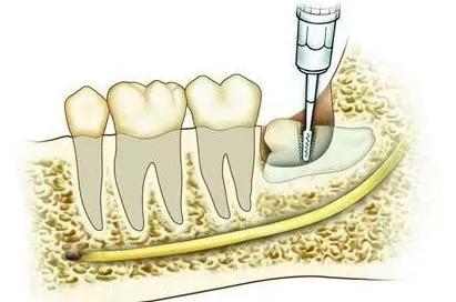 俞灏明牙龈上火原因,俞灏明牙龈上火了吗
