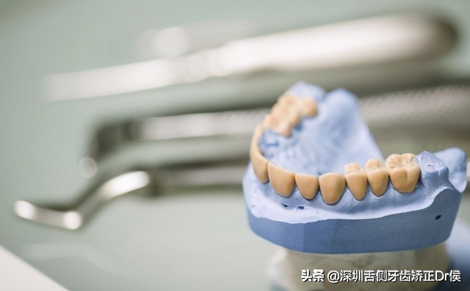 牙齿矫正神器价格,牙齿矫正支撑钉图片