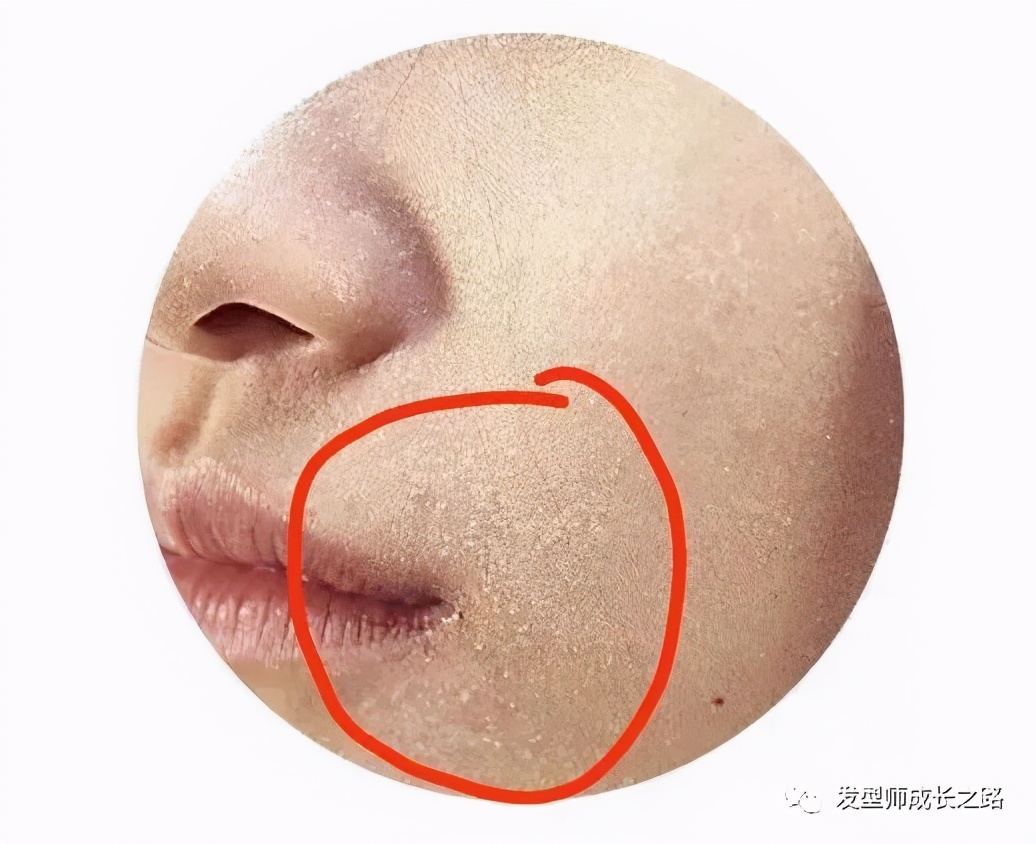 头皮屑的真正原因,头皮屑基础了解