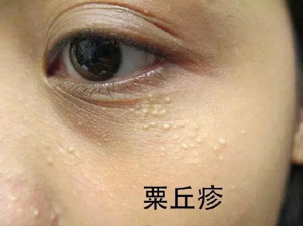 维生素e能除眼周的脂肪粒吗,消除眼周脂肪粒最好方法