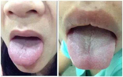 舌头辨体质,看舌头能看出几种体质