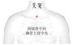 得了支气管炎咳嗽痰多怎么办,支气管炎咳嗽吐白痰能坐艾灸凳吗