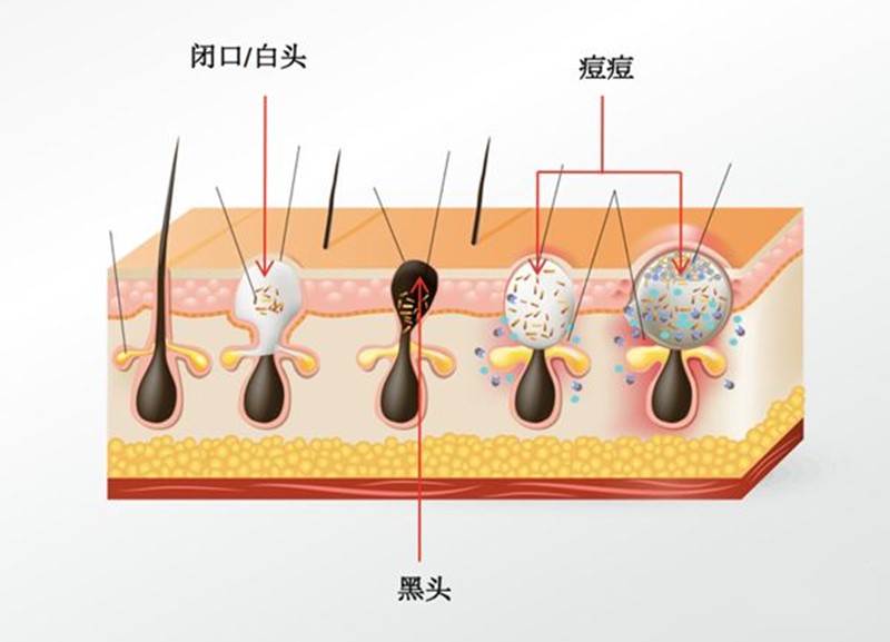 闭口反反复复长到底怎样才能根治,闭口反反复复长怎么办