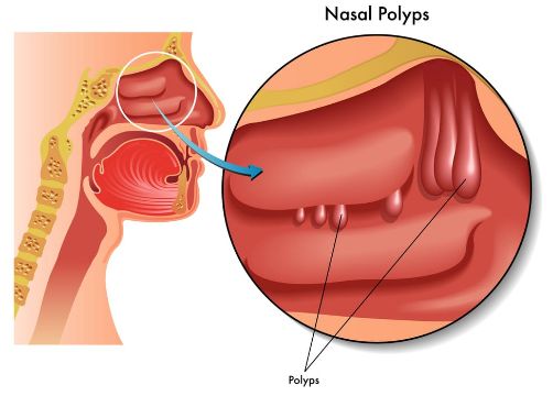 鼻窦炎盐酸溴己新片,鼻窦炎生物制剂进展