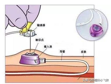 化疗埋管保证治疗顺利进行，一旦药物外渗患者遭罪又耽误治疗