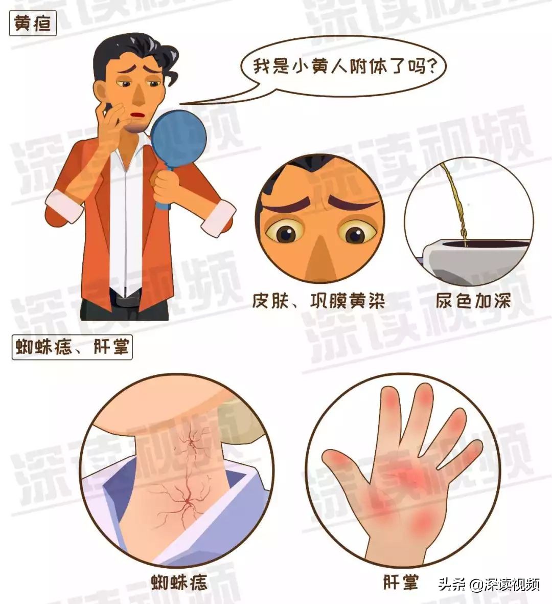 早期肝硬化有什么蛛丝马迹吗,如何判定早期肝硬化和晚期肝硬化