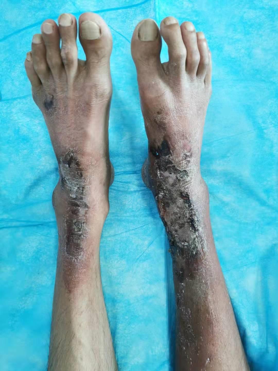 下肢麻木、溃烂要小心，烟酸缺乏是病因