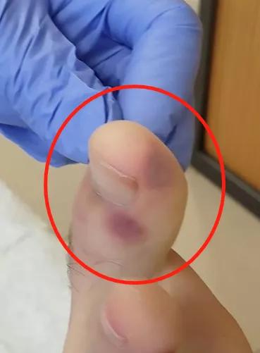 新冠诱发疱疹,新冠病毒脚上起痘