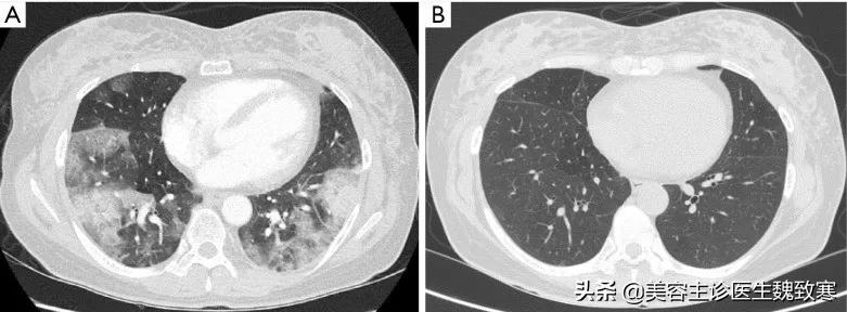 私密整形术后一直出血,私密整形引发肺栓塞
