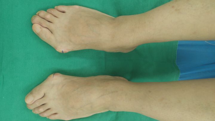 脚大拇外翻和痛风有什么区别,大脚趾痛风和拇外翻的区别