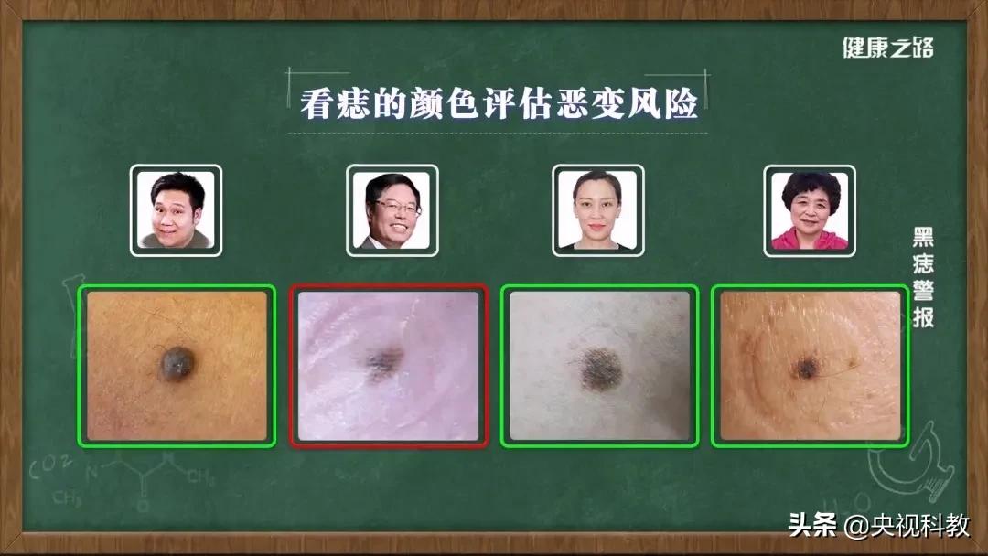 黑痣很容易恶变吗,身上黑痣出现什么状况有癌变发生