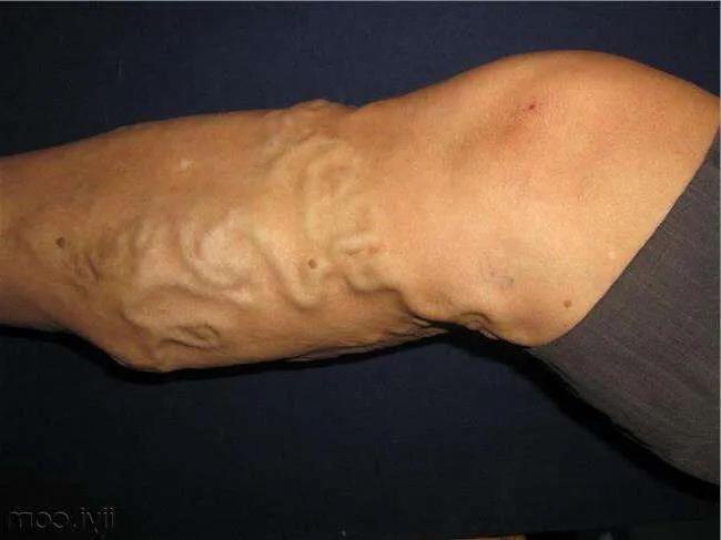 下肢静脉曲张等血管疾病是脉管炎吗？