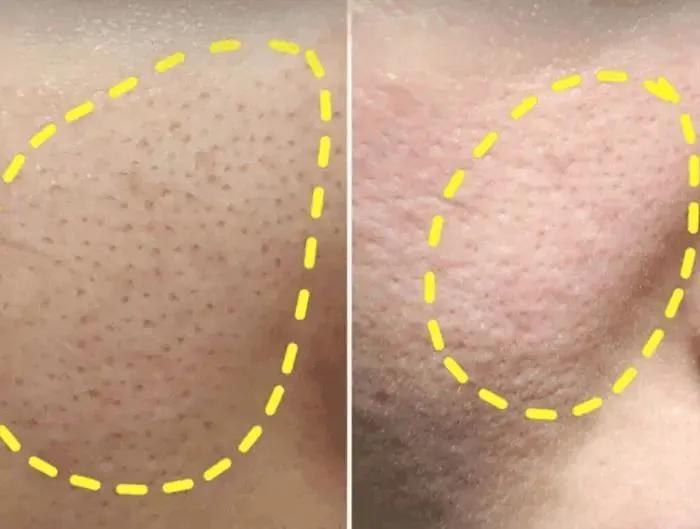 听说你毛孔大到可以放芝麻，该怎么办？