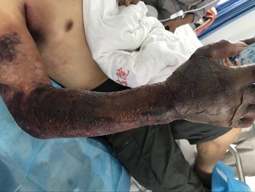 抗洪战士被毒蛇咬了,被剧毒蛇咬伤医生救援