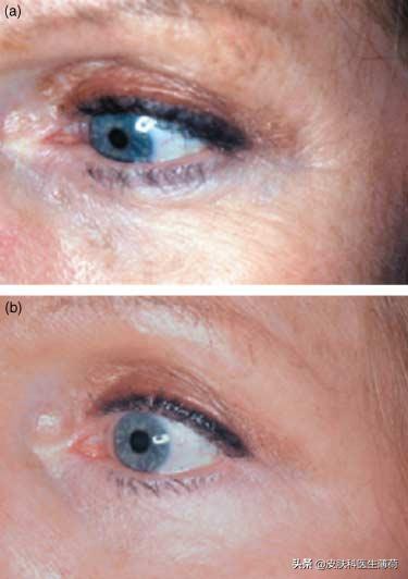 如何防止光老化氧化,预防光老化的最佳方法