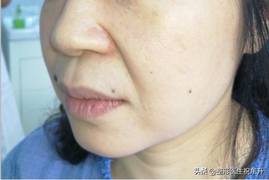 法令纹不做医美可以去除吗,祛除法令纹做什么手术效果好