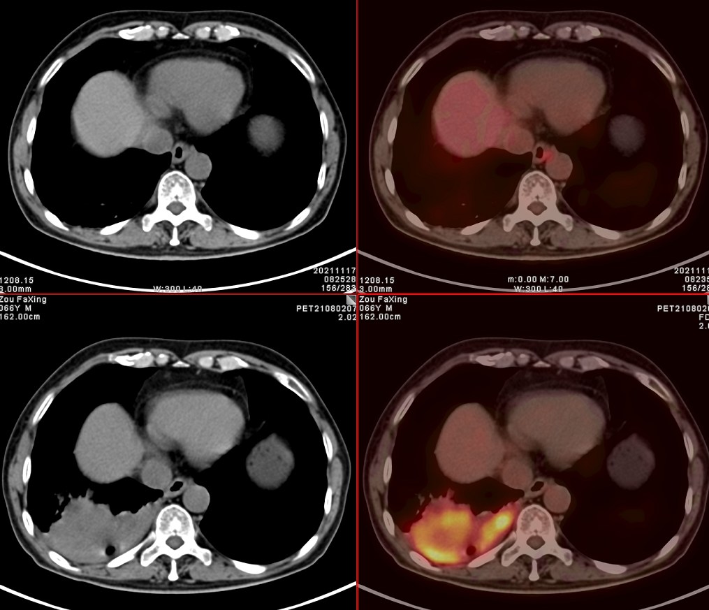 petct肺癌晚期必须要做吗,肺癌患者petct