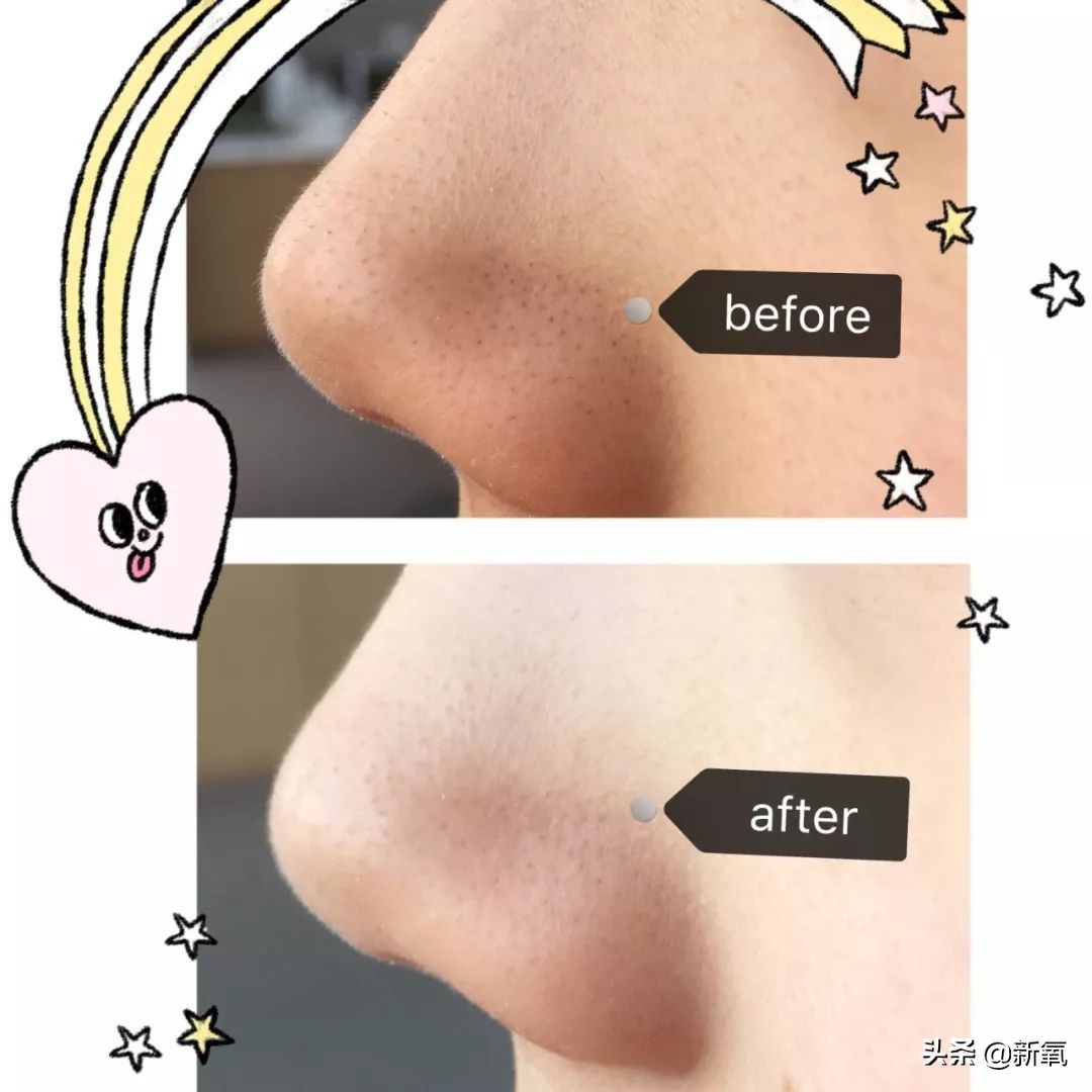 去黑头最有效的方法一个月见效,别挤了教你去黑头的正确方法