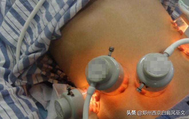 白斑病的有效治疗方法,皮肤白斑病的症状及治疗方法