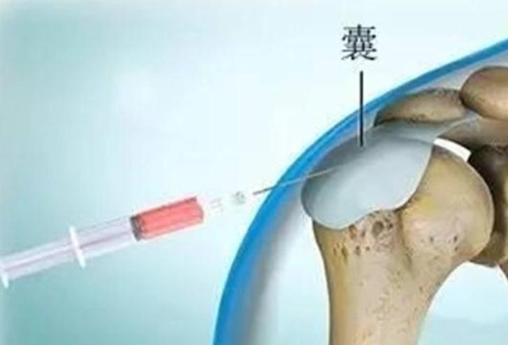 关节封闭针怎么打,关节疼打封闭针视频