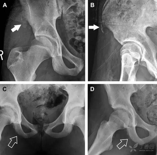 常见的八种骨折,容易漏诊的肩关节骨折