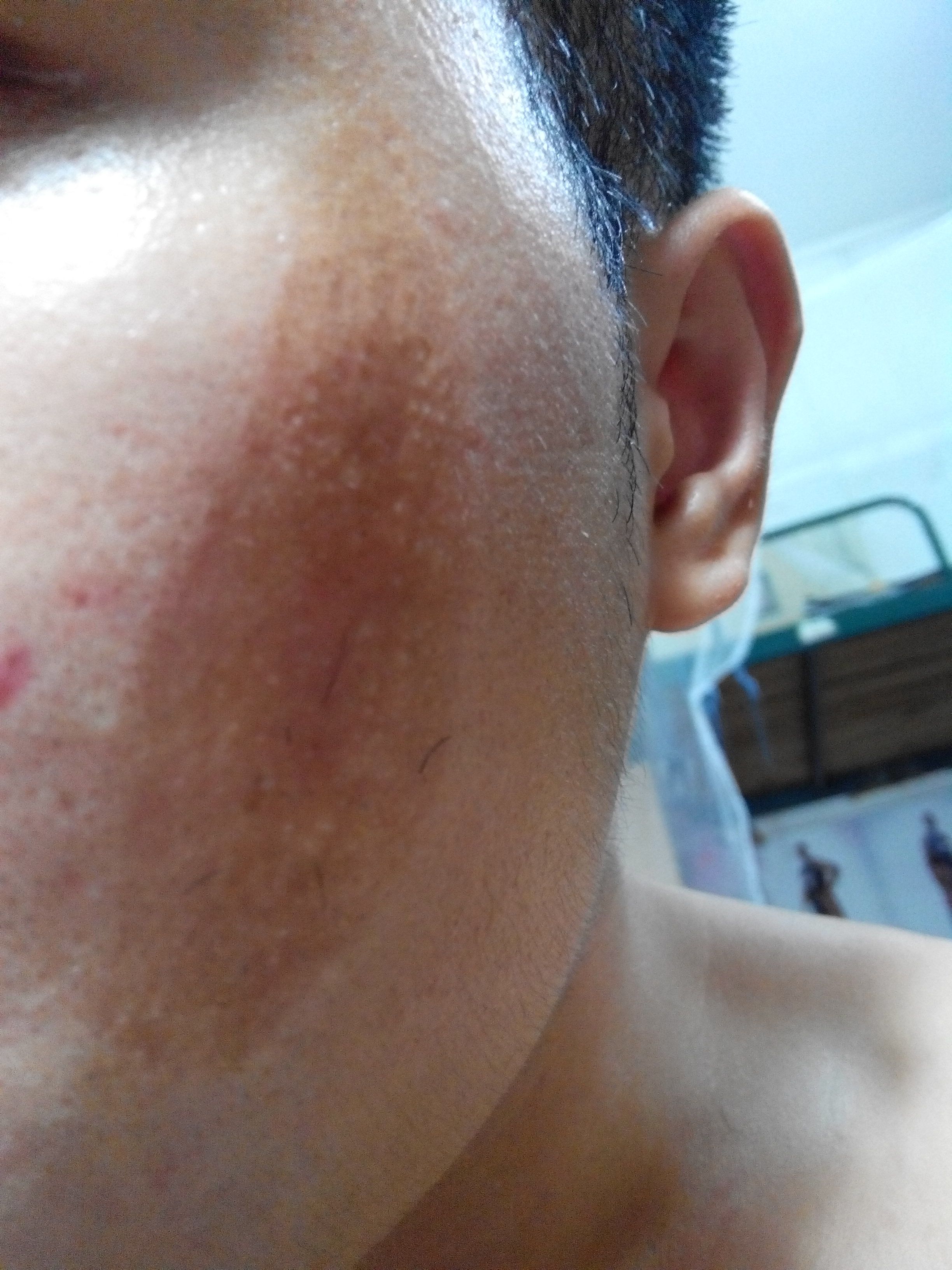 伤疤好了之后有黑色素怎么办,伤疤黑色素沉淀的解决办法