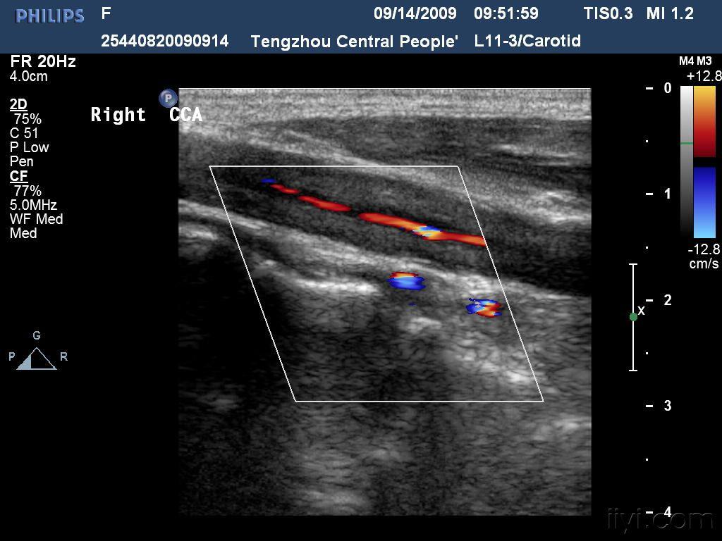 播散性嗜酸性粒细胞增多什么意思,嗜酸性粒细胞增多症血液病
