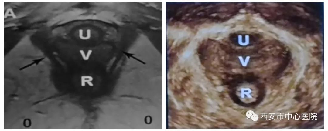 【大写的尴尬】大笑咳嗽时尿*禁失**了——四维超声带你认识盆底健康