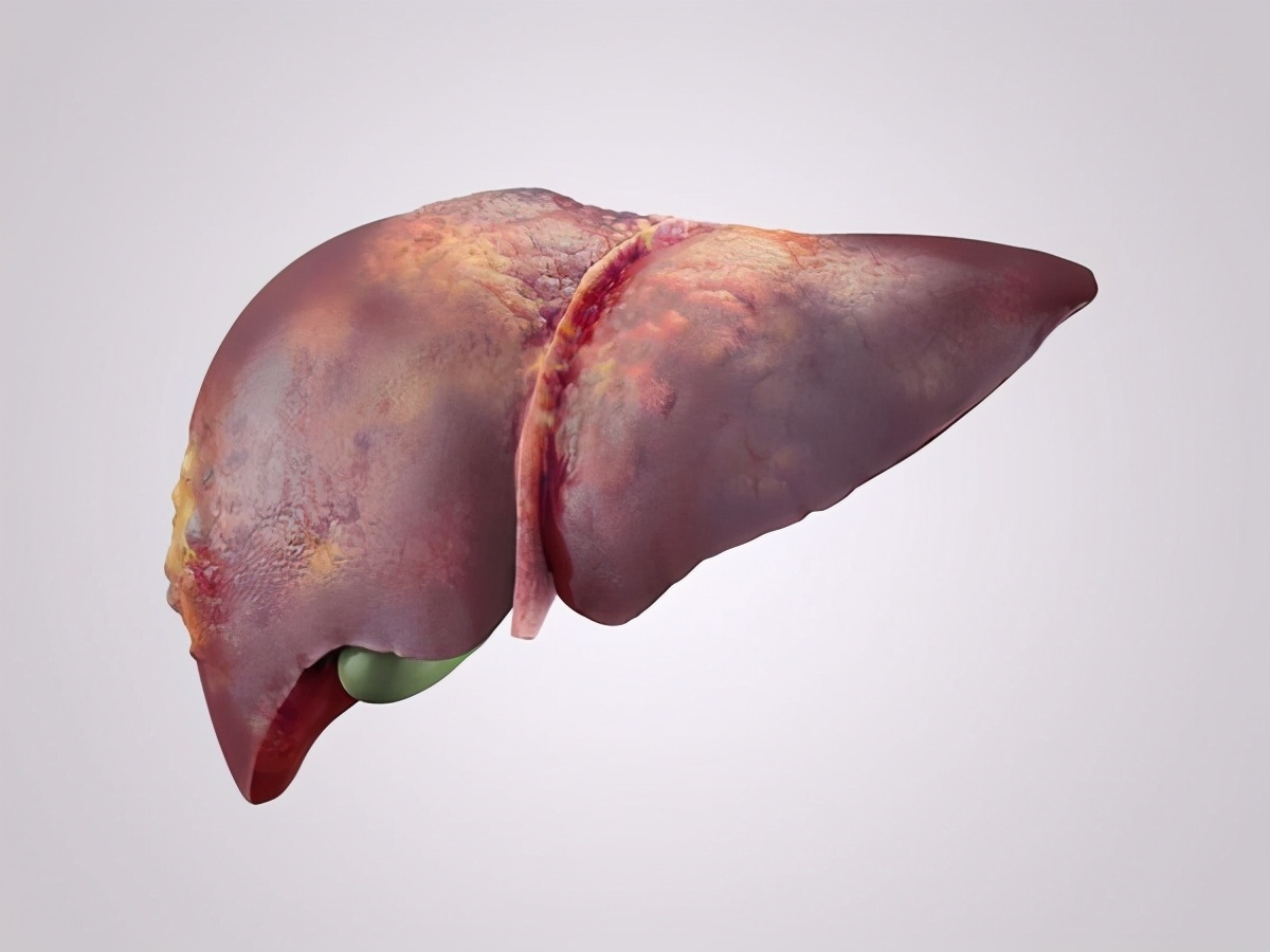 肝癌出现腹水肚子胀意味着什么,弥漫性肝癌晚期怎么解决腹胀腹水