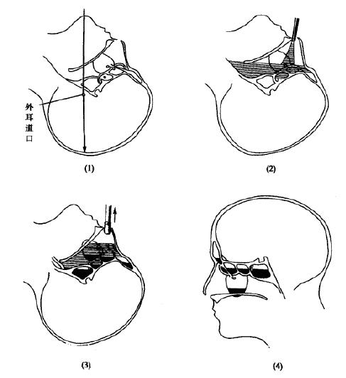 为什么鼻窦炎会前额疼,鼻窦炎会引起头痛牙痛吗