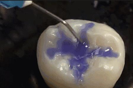 窝沟封闭适合几岁孩子做,在家给娃做窝沟封闭