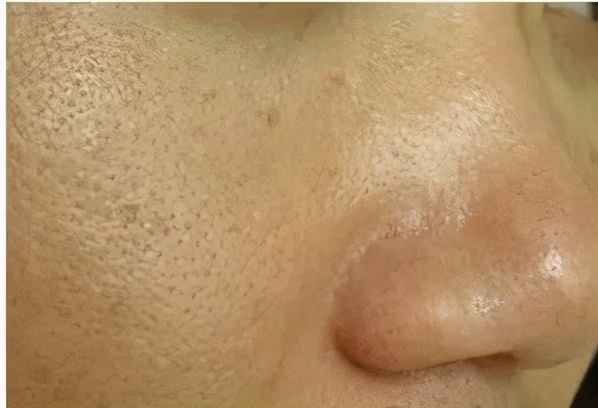 毛孔粗大别怕有办法,毛孔粗大了十几年还有救吗