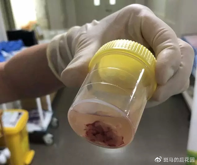 腺样体肥大对长大有什么影响,腺样体长大就萎缩害了多少孩子
