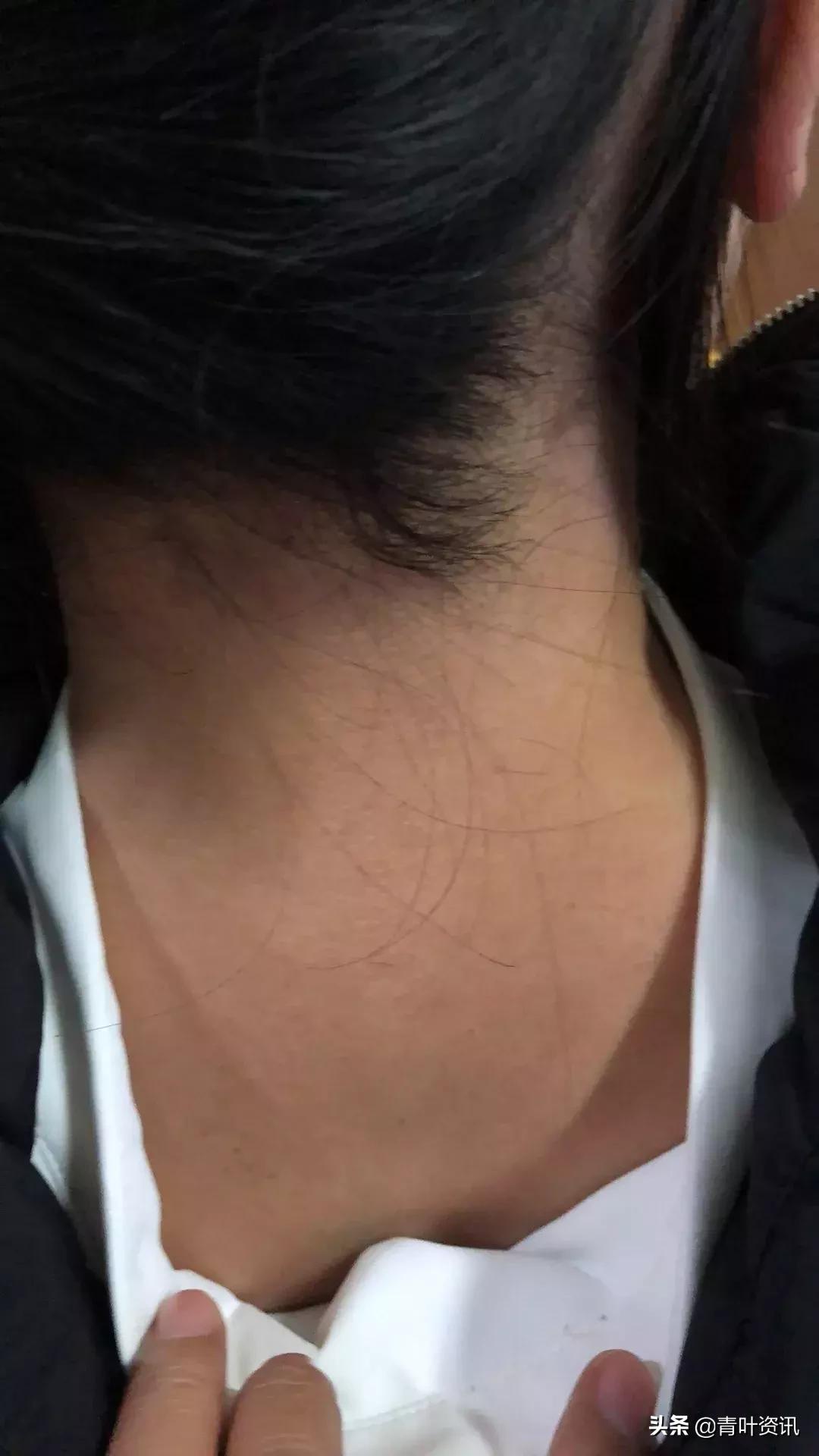 吃火锅过敏起红疹子,夏天吃火锅过敏